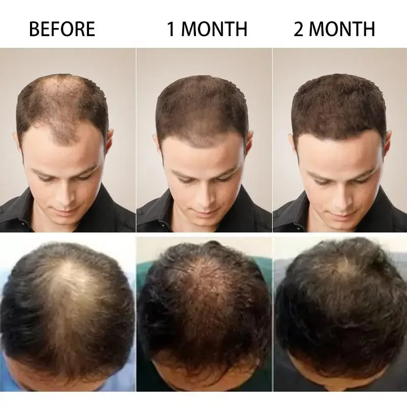 Wzrost włosów Imbir Szybko ros – Hair Care Essential Oil Atomizing recenzja i cena
